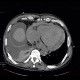 Hemopericardium, aortic valve replacement: CT - Computed tomography